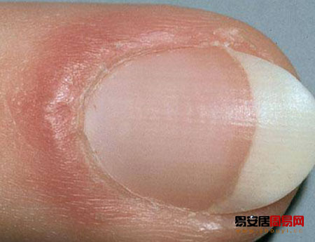 指甲周圍紅腫