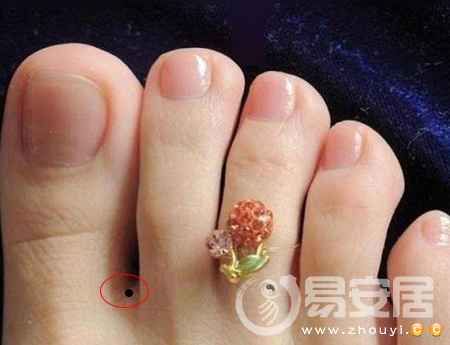 腳趾縫間長痣
